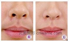 冰點(diǎn)脫毛幾個月會長出來