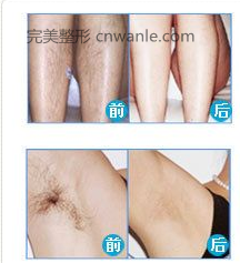 脫毛<a href='/tag_qianhouduibi.html'>前后對(duì)比</a>照