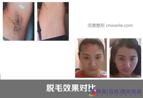 冰點(diǎn)脫毛的優(yōu)勢有哪些？冰點(diǎn)脫毛