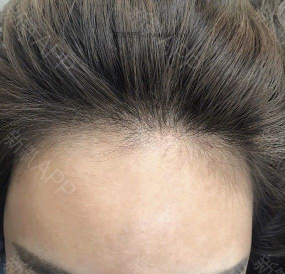 半永久紋發(fā)際線