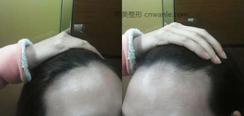 女生發(fā)際線后移
