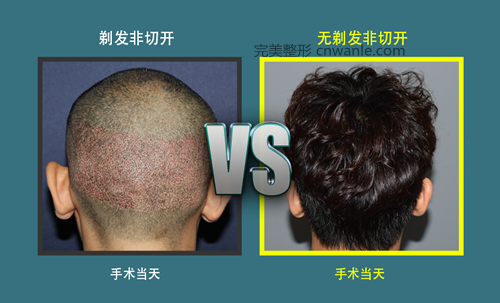 不剃頭非切開的毛囊移植法