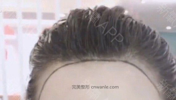 半永久紋發(fā)際線
