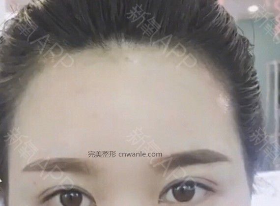 半永久紋發(fā)際線