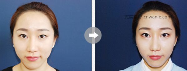 發(fā)際線移植案例對圖