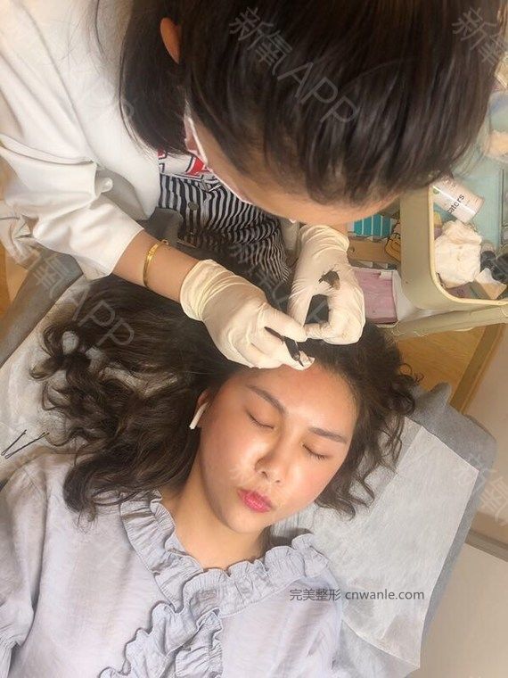 半永久紋發(fā)際線