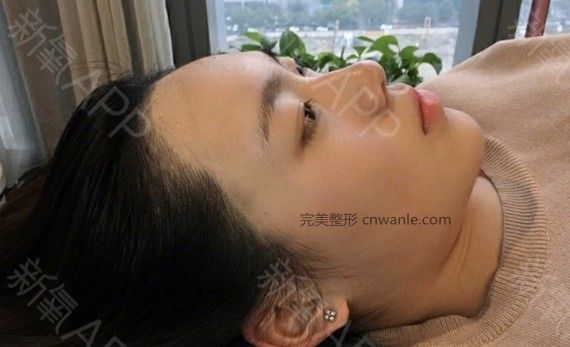 半永久紋發(fā)際線