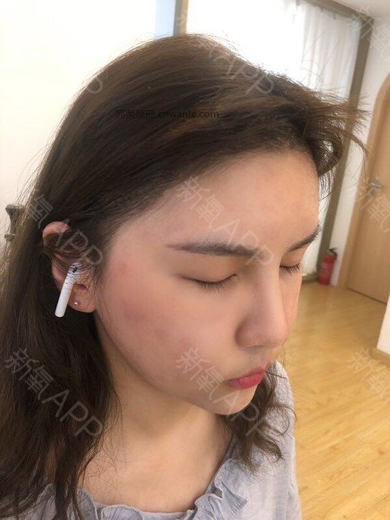 半永久紋發(fā)際線