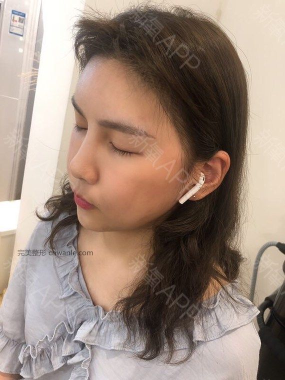 半永久紋發(fā)際線