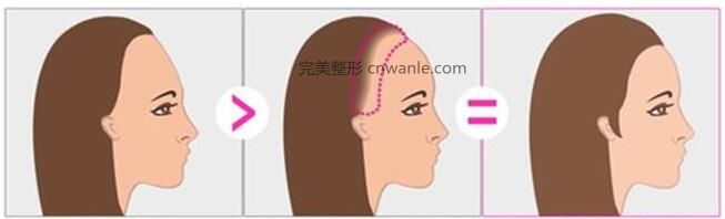 紋發(fā)際線(xiàn)效果