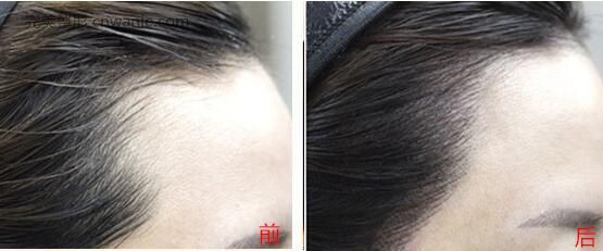 <a href='/tag_banyongjiu.html'>半永久</a>紋發(fā)際線(xiàn)