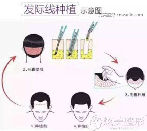 <a href='/tag_fajixianyizhi.html'>發(fā)際線移植</a>手術原理