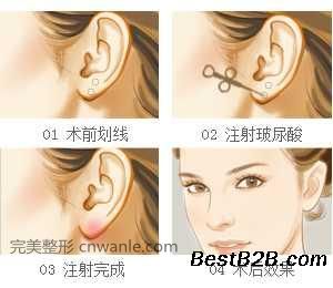 <a href='/tag_zhusheboniaosuan2.html'>注射玻尿酸</a>豐耳垂