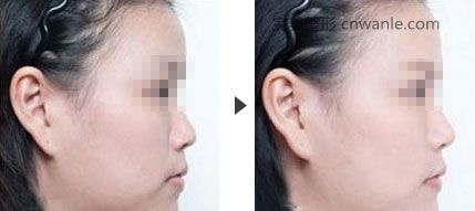 豐耳垂——讓你更具有福氣象征