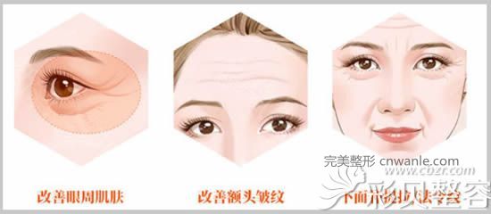電波拉皮除皺