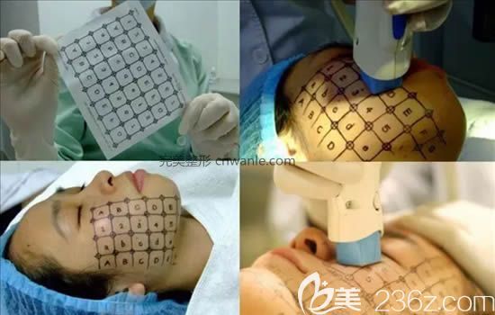 電波拉皮操作過程圖