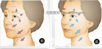 長春哪家醫(yī)院做<a href='/tag_lapichuzhou10.html'>拉皮除皺</a>術(shù)好