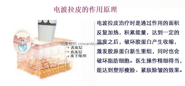 電波拉皮的原理