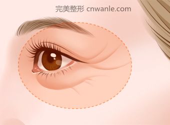 電波拉皮有什么樣的效果？