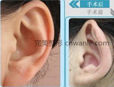 耳畸形矯正手術(shù)禁忌癥