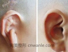 耳垂損傷矯正術(shù)