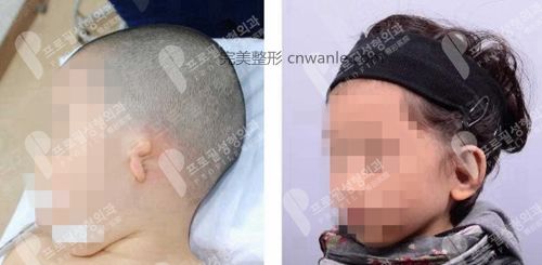 韓國(guó)profile普羅菲耳整形醫(yī)院小耳癥矯正案例