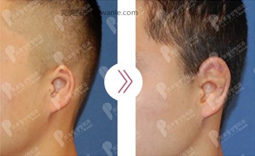 韓國(guó)profile普羅菲耳整形醫(yī)院外耳廓畸形矯正案例