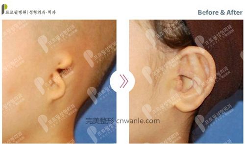 韓國(guó)profile普羅菲耳整形醫(yī)院小耳癥矯正案例