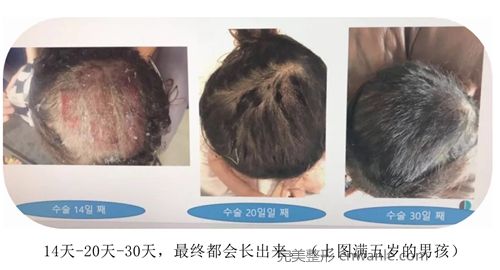 韓國(guó)profile普羅菲耳整形醫(yī)院頭皮取皮后恢復(fù)
