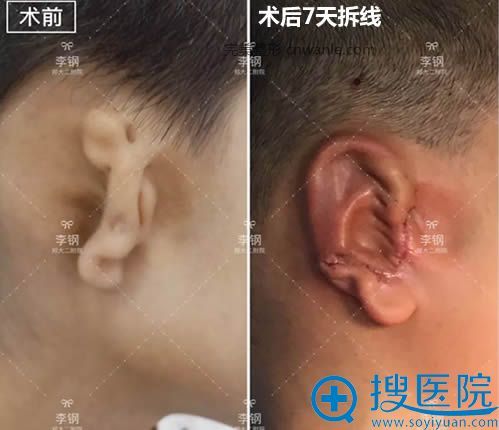 一期耳再造術后7天拆線后的照片