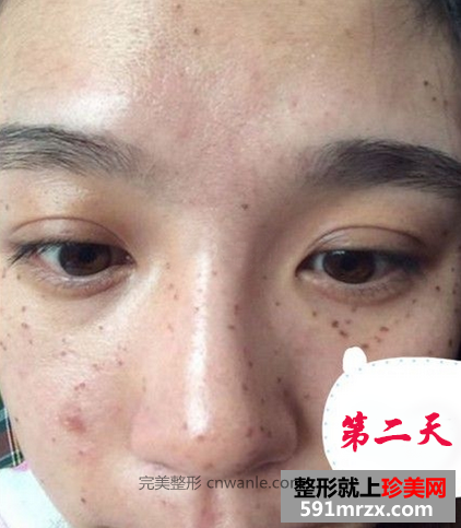 激光去斑效果如何 激光祛斑前后對(duì)比圖