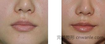 口角不對(duì)稱(chēng)整形后案例