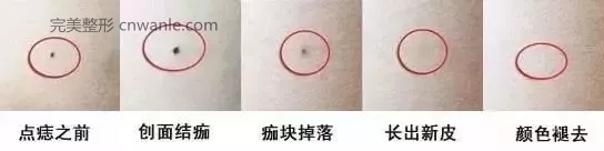 杭州激光祛痣效果如何？