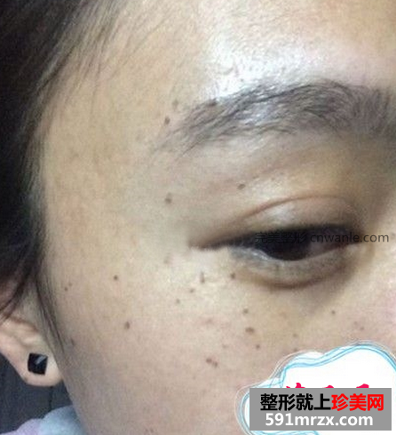 激光去斑效果如何 激光祛斑前后對(duì)比圖