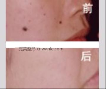 激光祛痣效果怎么樣呢