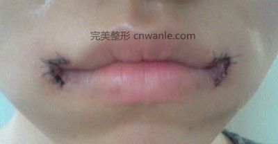 嘴角上提術(shù)