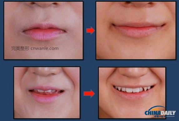 近幾個(gè)月來，一種被稱為“Smile Lipt”的嘴角<a href='/tag_zhengrong3.html'>整容</a>手術(shù)在韓國非常風(fēng)靡。該手術(shù)將嘴角切開再縫合，重新調(diào)整上下顎的角度，使得嘴部的線條更柔和。