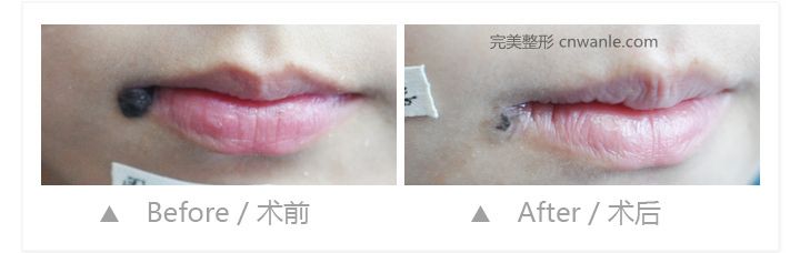 激光祛痣的優(yōu)勢(shì)有哪些?效果如何?