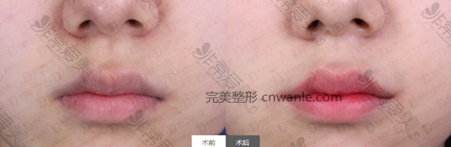 女神醫(yī)院唇部整形案例對比