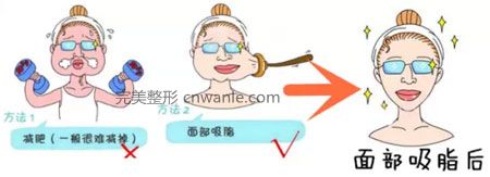 <a href='/tag_mianbuxizhishou4.html'>面部吸脂瘦臉</a>效果