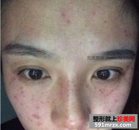 激光去斑效果如何 激光祛斑前后對(duì)比圖