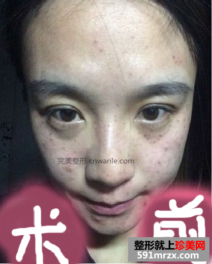 <a href='/tag_jiguangquban52.html'>激光去斑</a>效果如何 激光祛斑<a href='/tag_qianhouduibi.html'>前后對(duì)比</a>圖