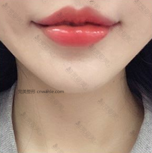 HB整形醫(yī)院唇部整形效果