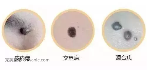 杭州激光祛痣效果如何？