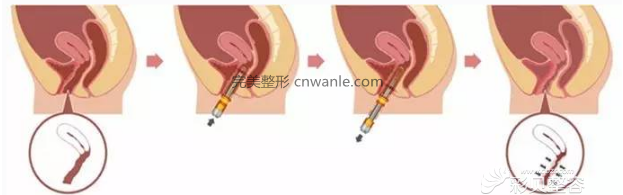 廣州華美Fotona青春私密激光治療原理圖