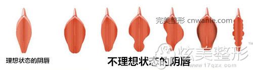 陰唇整形