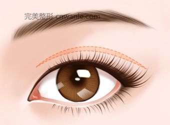 開(kāi)眼角