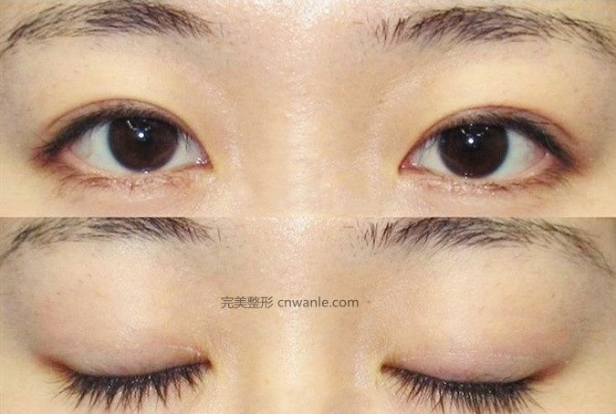 貴陽<a href='/tag_zuoshuangyanpi17.html'>做雙眼皮</a>開眼角|割雙眼皮一定要開眼角嗎？