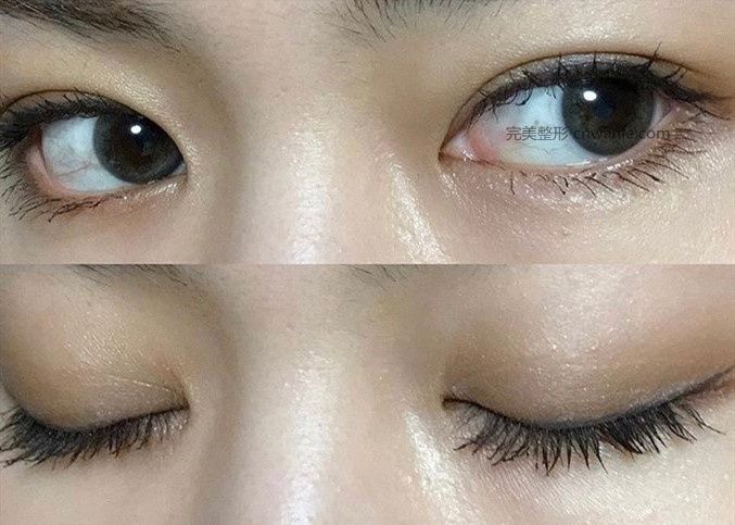 貴陽做<a href='/tag_shuangyanpikaiyan.html'>雙眼皮開眼角</a>|割雙眼皮一定要開眼角嗎？