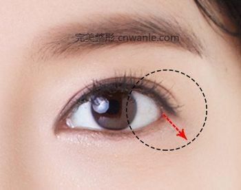 開內(nèi)眥手術(shù)